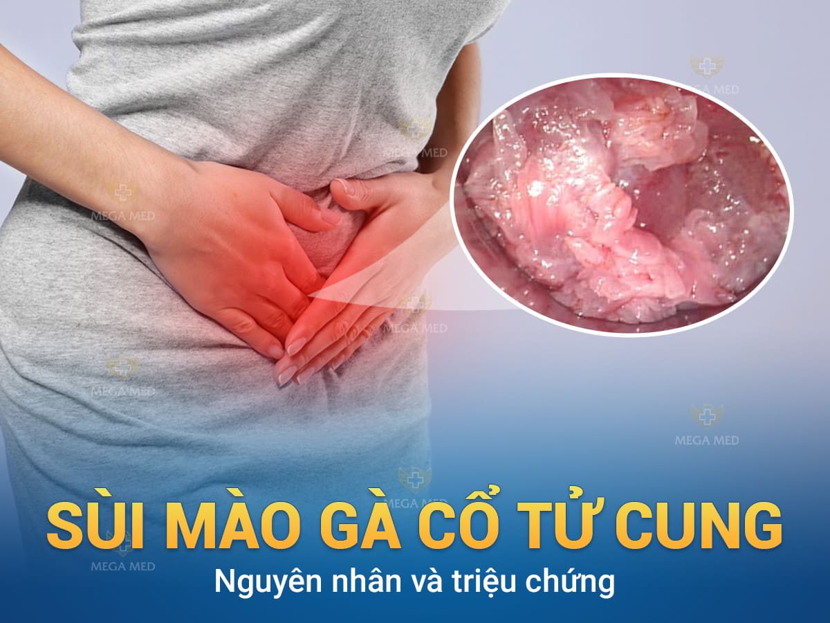 Sùi mào gà cổ tử cung